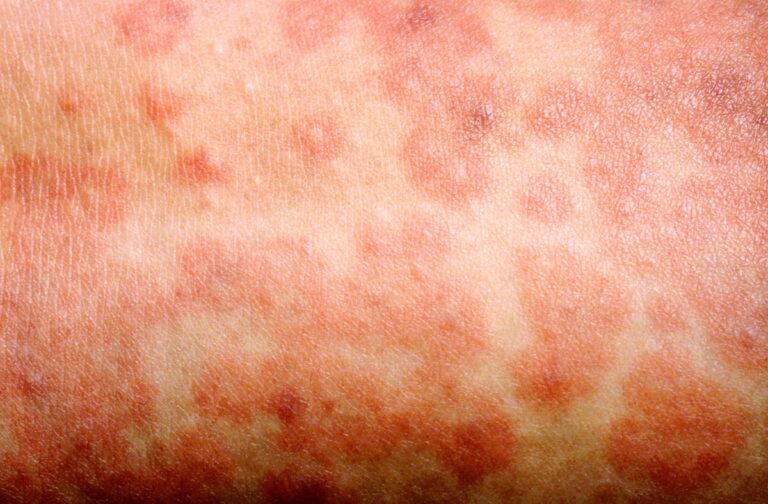 measles rash