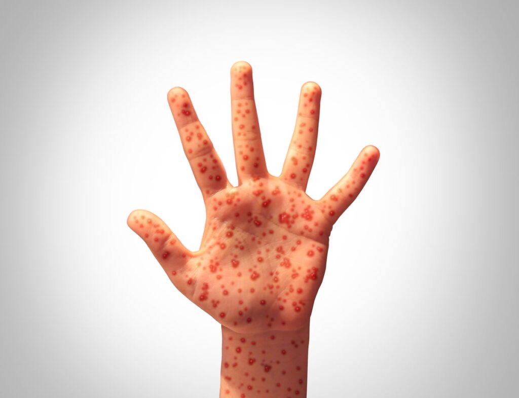 Hand with measles
